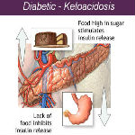 Proper E-code for Diabetic with Ketoacidosis — VIDEO